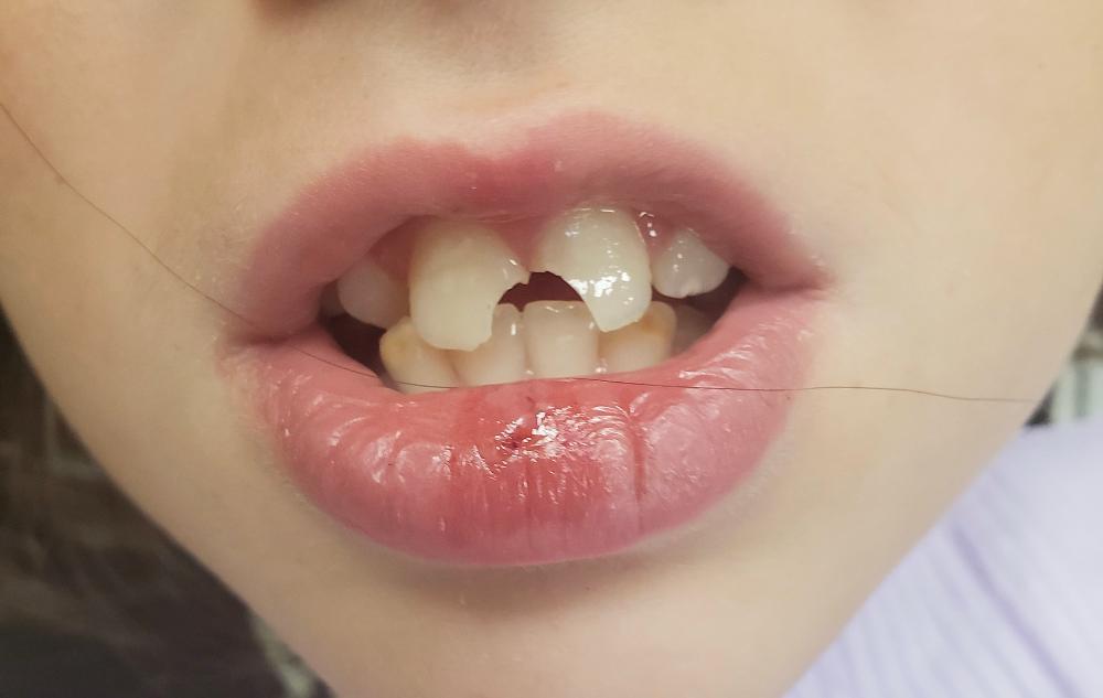 laser dentistry | tecumseh mi 